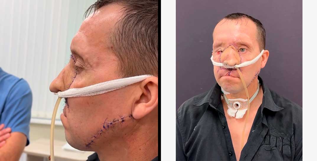 Белорусские хирурги совершают чудеса — нос, который вырастили на руке, пришили на свое место