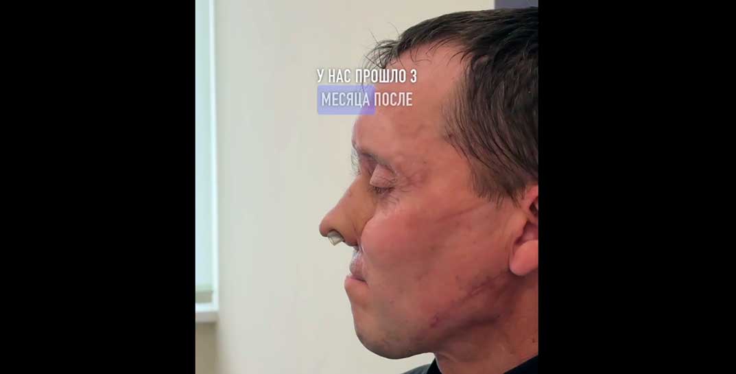 Помните белоруса, которому доктора вырастили новый нос на руке? Мужчина уже вышел на работу