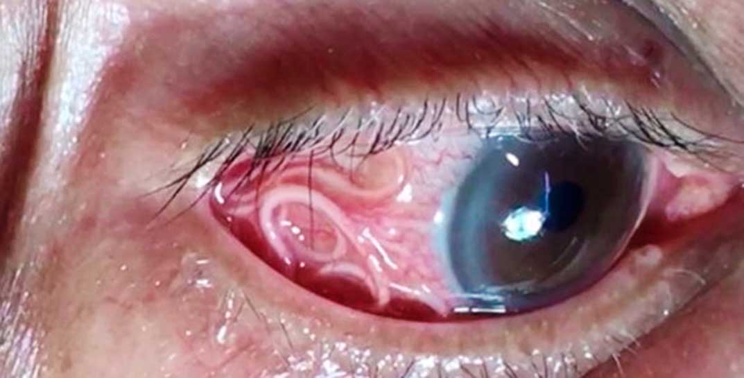 Белорусские комары могут заразить гельминтом, который передвигается под кожей и способен проникнуть даже в глаз
