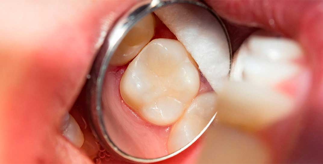 Тарифы на лечение зубов снова уменьшили. Повлияло ли это на цены в стоматологиях?