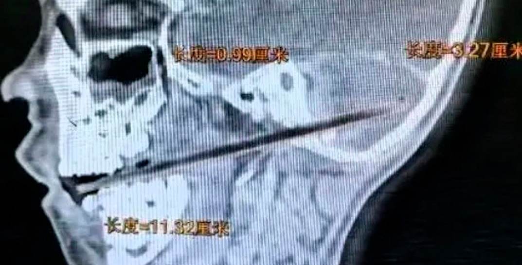 В Китае мальчик чуть не умер. Всему виной пронзивший его череп леденец