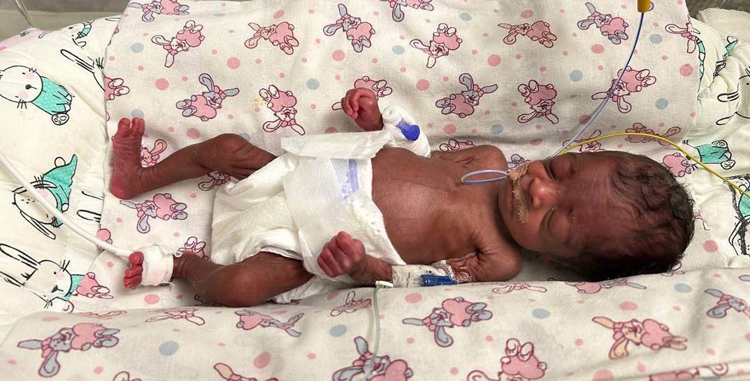 Белорусские медики выходили новорожденную девочку весом 600 грамм