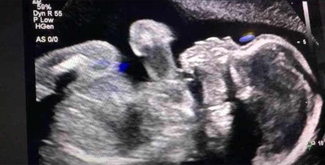 В Америке умершая женщина вынашивает ребенка, потому что в штате запрещены аборты