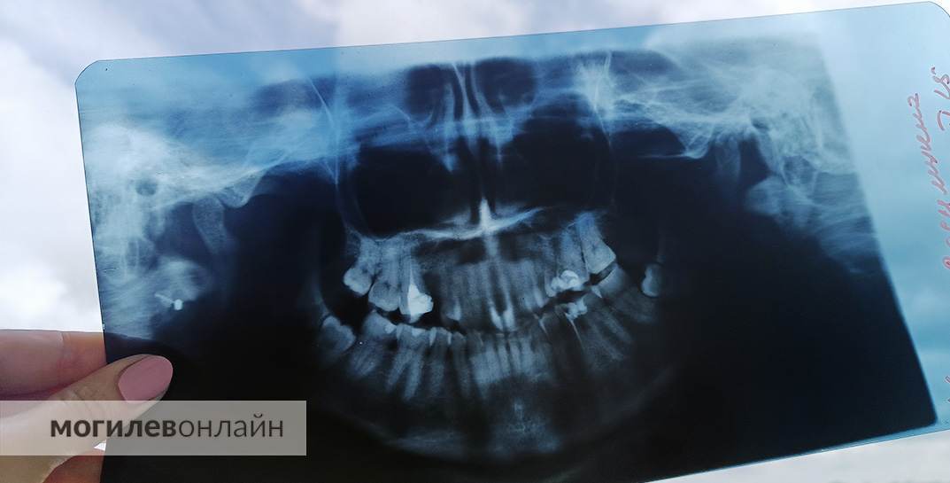 «Врач не в состоянии уделить достаточно внимания пациентам». После некачественного удаления зуба белорус отсудил у стоматологии 800 рублей