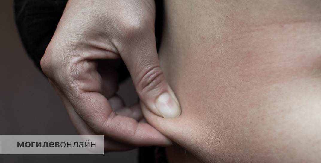 Пластическая операция под седацией обернулась для белоруски двумя клиническими смертями. Теперь она пытается отсудить у клиники $50 тысяч