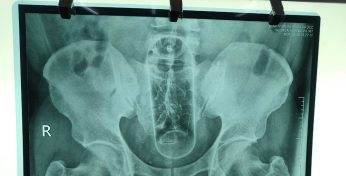 От секс-игрушек до скалки: белорусский проктолог рассказал об удивительных находках в заднем проходе пациентов