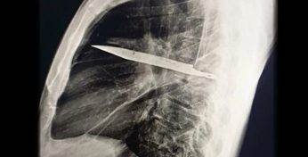 Житель Танзании 8 лет проходил с лезвием ножа в груди и не знал об этом