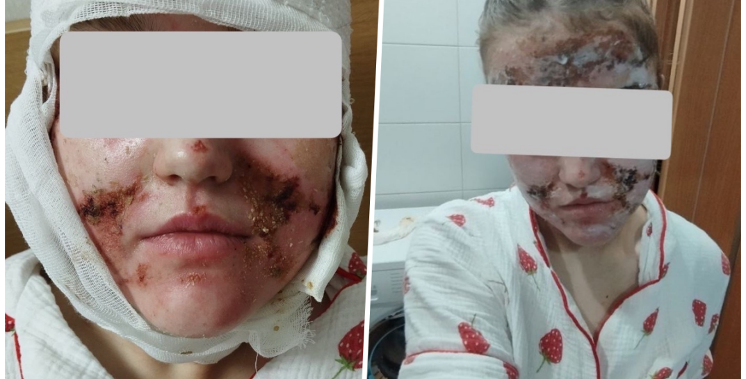 Девочка из Гродно получила химический ожог лица от энзимной пудры из магазина