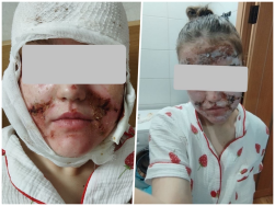 Девочка из Гродно получила химический ожог лица от энзимной пудры из магазина