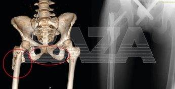 «Девушка-кошка». 18-летняя россиянка упала с 9 этажа и осталась жива