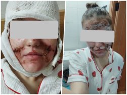 Девочка из Гродно получила химический ожог лица от энзимной пудры из магазина